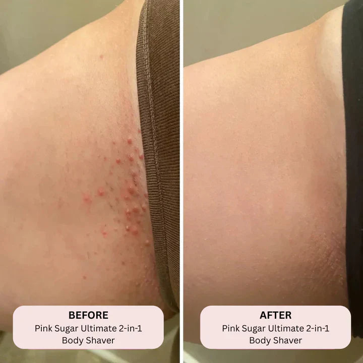 THE ULTIMATE BIKINI TRIMMER - BLUE MOUNT™